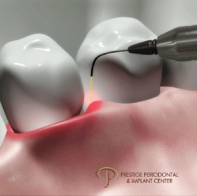 trend of laser services in dental sector