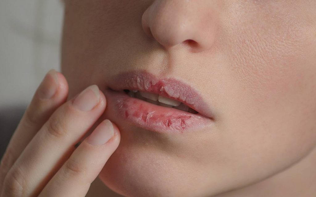 Dried lips - Broken & Cracked Skin